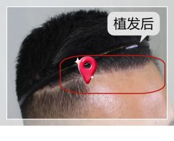 -大麦微针植发全国连锁