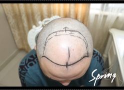 -大麦微针植发全国连锁