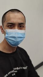 -大麦微针植发全国连锁