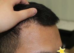 -大麦微针植发丨全国连锁