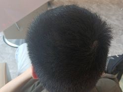 -碧莲盛·不剃发植发