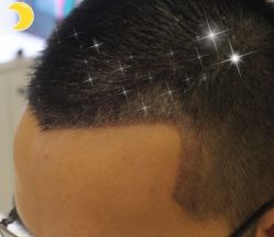 -大麦微针植发丨全国连锁