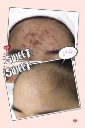 -痘博士烟台·全国连锁祛痘机构