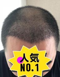 -大麦微针植发丨全国连锁