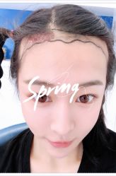 体验后-大麦微针植发全国连锁