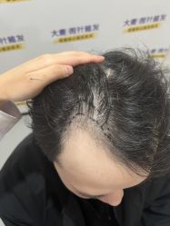 -大麦微针植发全国连锁