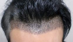 -大麦微针植发丨全国连锁