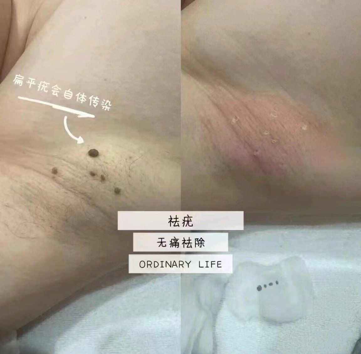 腋下肉揪祛除干净啦