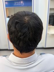 -大麦微针植发全国连锁