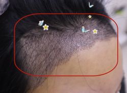 -大麦微针植发全国连锁