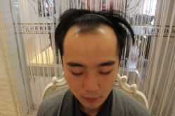 点击看大图 -大麦微针植发丨全国连锁