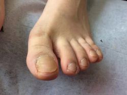 -德哥灰指甲脚气甲沟炎跖疣护理
