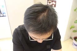 -大麦微针植发丨全国连锁