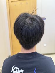-大麦微针植发全国连锁