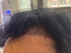 -碧莲盛·不剃发植发