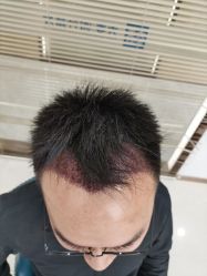 -大麦微针植发丨全国连锁