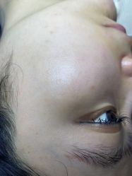 体验后-爱莎扁平疣·汗管瘤·斑痣中心