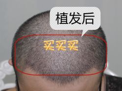 -大麦微针植发全国连锁