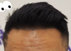 -大麦微针植发全国连锁