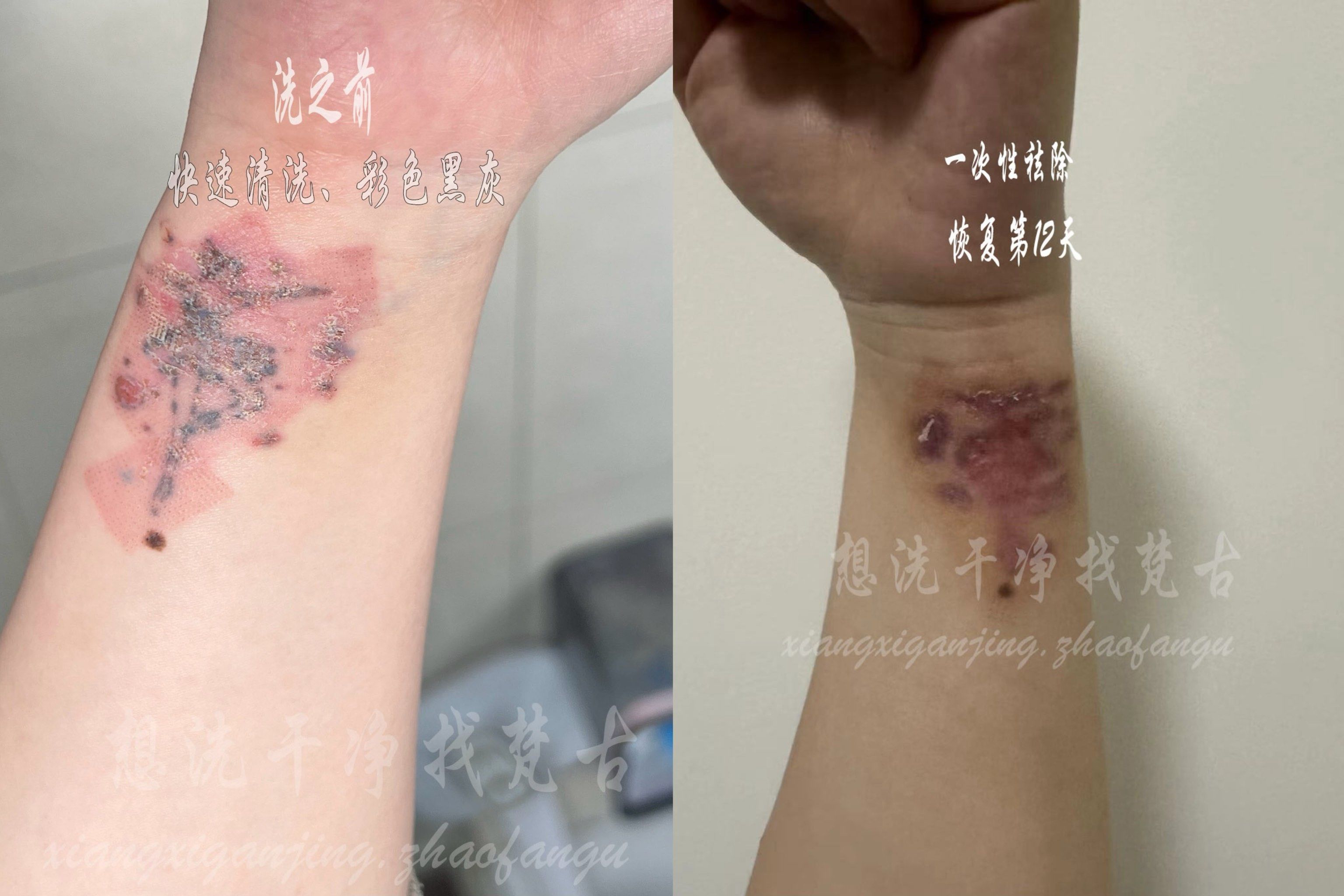 客户刚洗完5天的纹身,觉得颜色掉色不理想
找到我们做的一次性祛除
