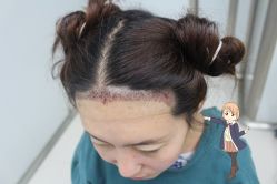 -大麦微针植发丨全国连锁