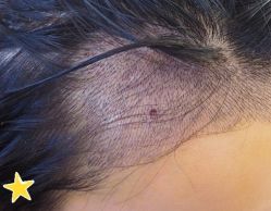 -大麦微针植发丨全国连锁