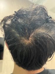 -大麦微针植发全国连锁