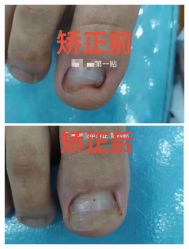 -德哥灰指甲脚气甲沟炎跖疣护理