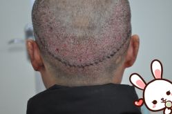 -大麦微针植发丨全国连锁