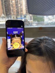 -碧莲盛·不剃发植发