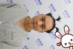 -大麦微针植发丨全国连锁