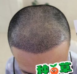 -大麦微针植发丨全国连锁