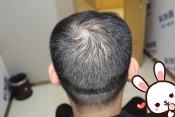 -大麦微针植发丨全国连锁