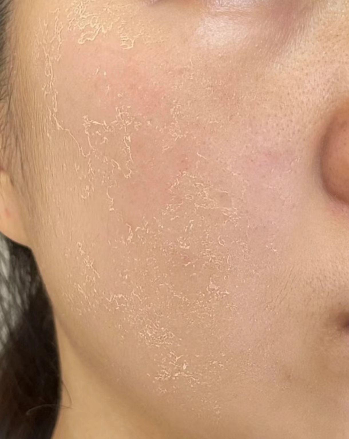 谁懂!秋冬脸鼻翼干燥起皮痒泛红真的太痛