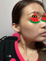 体验后-More摩尔医美の注射线雕光电中心