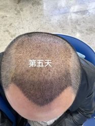 -大麦微针植发全国连锁