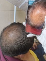 -碧莲盛·不剃发植发