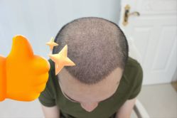 -大麦微针植发丨全国连锁