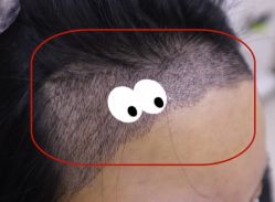 -大麦微针植发全国连锁