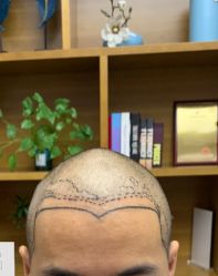 体验前-大麦微针植发全国连锁