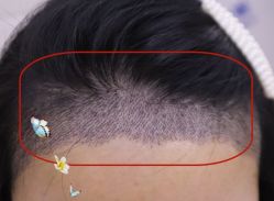 -大麦微针植发全国连锁