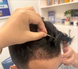 -大麦微针植发全国连锁
