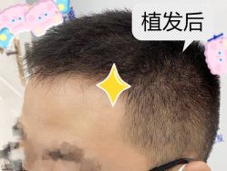 -大麦微针植发全国连锁