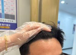 -大麦微针植发全国连锁