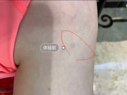 体验前-嘉和医学脱毛中心