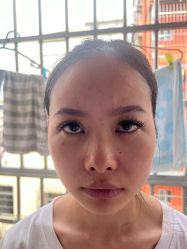 -广州健丽·去眼袋医疗美容机构