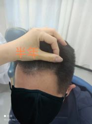 -大麦微针植发全国连锁