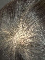 -碧莲盛·不剃发植发