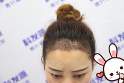 -大麦微针植发丨全国连锁