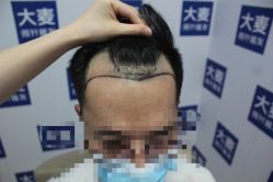 -大麦微针植发丨全国连锁